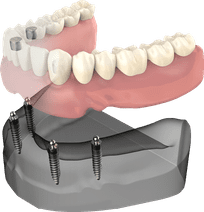 Dental implant model showing teeth prosthetic attachment to jawbone structure.