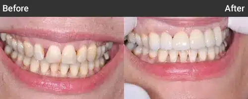 Before and after dental treatment comparison showing improved tooth alignment and whiteness at Moorhead Dental Associates.