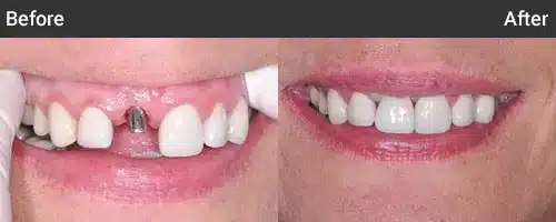 Before and after dental treatment showing improved tooth alignment and whiteness at Moorhead Dental Associates.