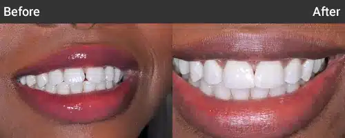 Before and after dental treatment showing improved tooth alignment and whiteness from Moorhead Dental Associates.