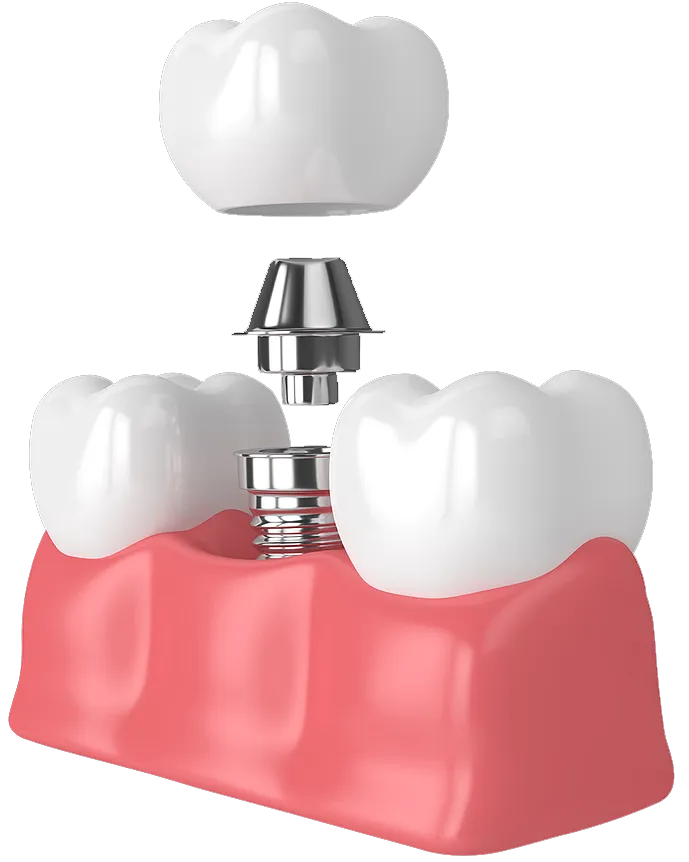 Dental implant diagram showing crown placement on implant post with surrounding teeth and gum tissue model.