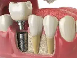 Dental implant diagram showing screw, abutment, and crown components in gum model.