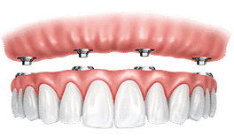 Dental implant prosthetic showing pink gum model above row of white tooth crowns.