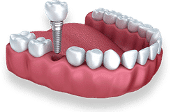 Dental implant model showing titanium screw fixture in pink gum replica with artificial tooth crown.